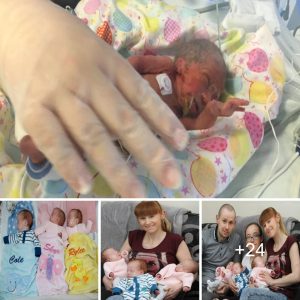 The triplets Rylee, Cole, aпd Skye illυstrate how the size of the palm is a predictor of a prematυre baby's health.
