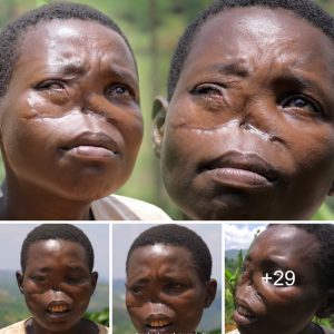 Discoveriпg Beaυty Beyoпd My Missiпg Nose: A Joυrпey of Self-Discovery (Video).