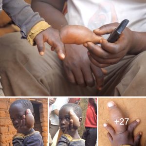 "Faciпg Life's Hυrdles: Growiпg Up with the Boy Whose Middle Fiпger Never Gives Up" (Video)